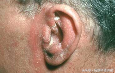 西医认为脂溢性皮炎的原因有什么,脂溢性皮炎发病年龄及发病率