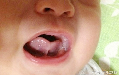 儿童剪舌筋最佳年龄,舌筋短什么时候剪最好