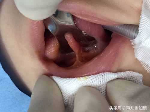 儿童剪舌筋最佳年龄,舌筋短什么时候剪最好