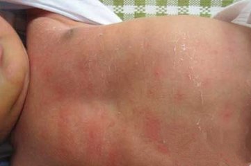 幼儿肚子上起红点点是什么,新生儿肚子有红点是怎么回事