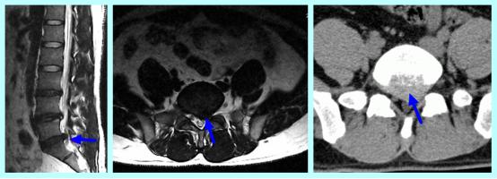 腰椎间盘突出手术切口位置,治疗腰椎间盘突出数千例