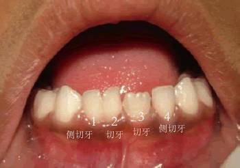 双牙重叠,连着两颗牙齿松动怎么办