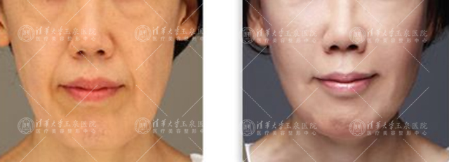 微针治痘有什么功效,微针治痤疮效果好吗