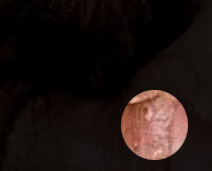 女性尖锐湿疣症状,尖锐性湿疣看什么科