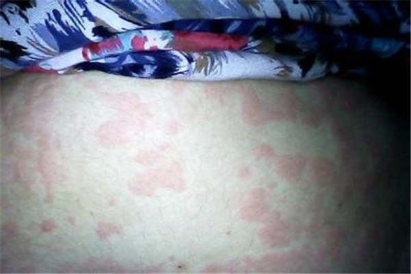 22岁男子因纹身而导致毁容的惨状,年轻小伙纹身中毒