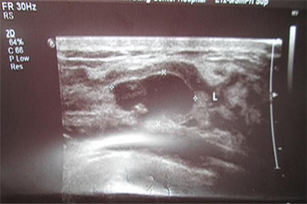 20岁的小女孩长纤维瘤,22岁小女孩怎么得乳腺纤维瘤