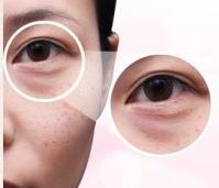 黑眼圈熊猫眼怎么去除,改善黑眼圈跟熊猫眼说再见