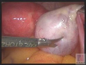 卵巢囊肿怎么无创治疗,卵巢囊肿怎么动手术没有伤口