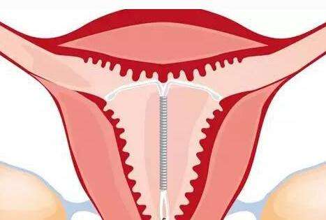 避孕环安静子宫里为什么不会脱落,避孕环怎样才可以自己脱落