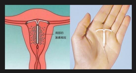 生完孩子上环一年后去取环,妇科上环7年了取了环会怀孕吗