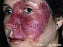 冷冻可以治疗鲜红斑痣胎记吗,治疗鲜红斑痣胎记的方法有哪些