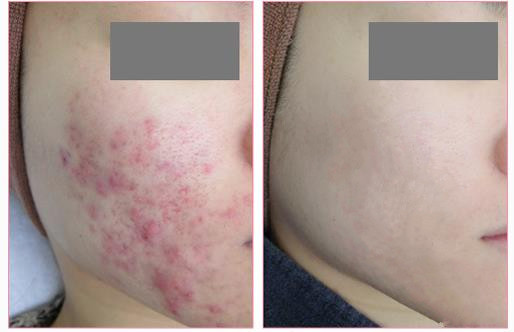 红蓝光祛除痘痘,红蓝光治痘痘方法