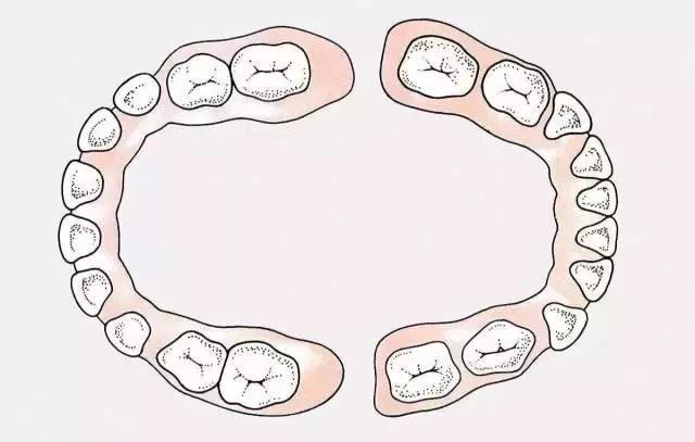 智齿导致旁边牙齿龋齿,智齿有龋齿有必要修补吗