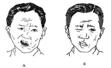 治疗面瘫最有效穴位,老人面瘫怎么治疗最好最快最有效