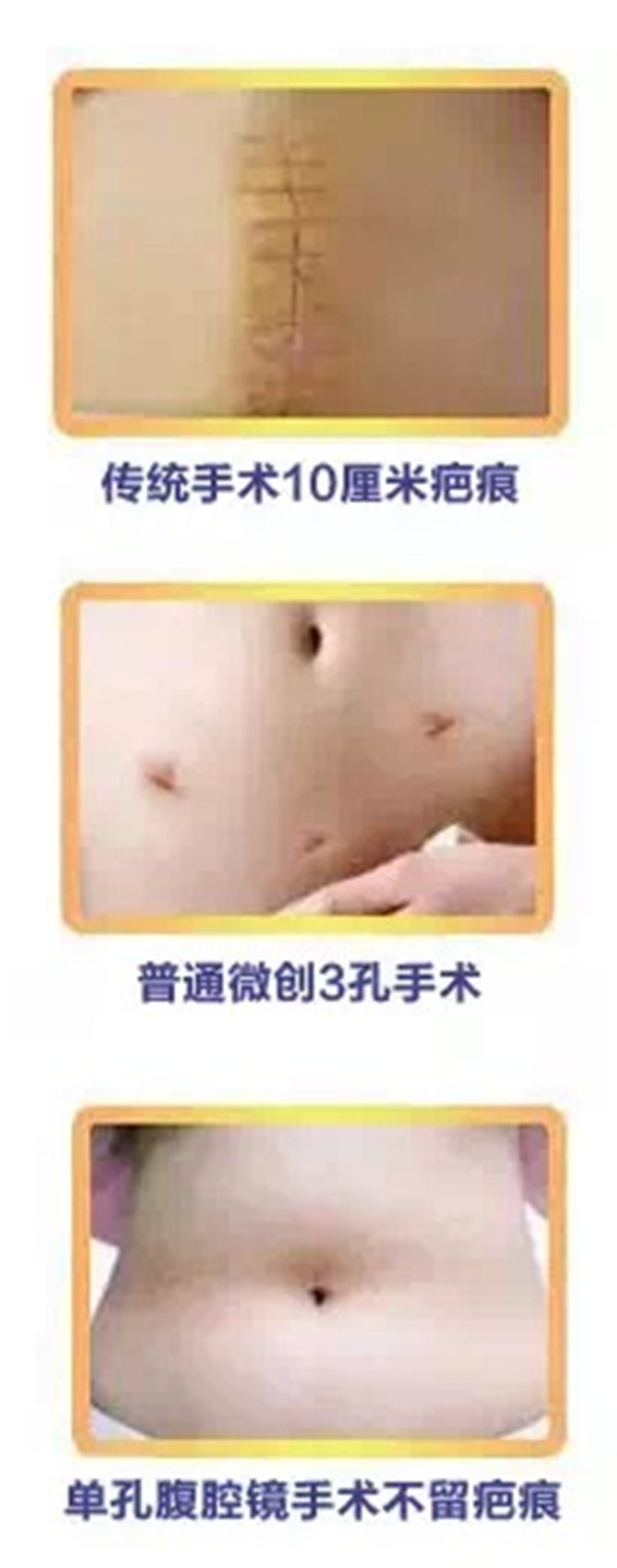 淄博莲池妇婴医院完成两例经脐单孔腹腔镜手术