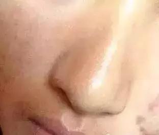 背后长了很多的小米粒用什么药,为什么会长了好多小米粒疙瘩