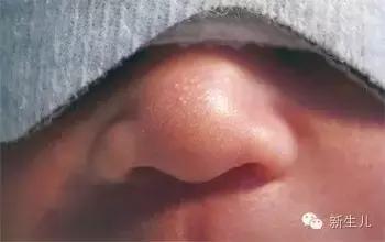 新生儿:婴儿皮肤起红疹?教你如何护理宝宝娇嫩的皮肤
