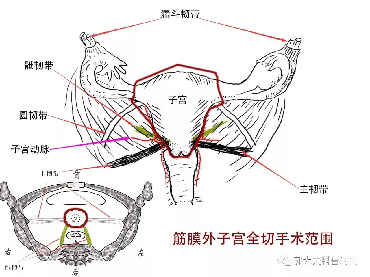 同样是子宫切除，切多一点，切少一点，区别是很大的！