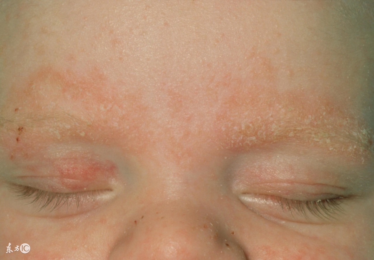 激素皮炎中医治疗,激素皮炎激素脸的特征