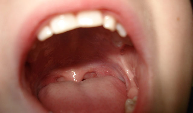 蛀牙牙疼怎么缓解最有效方法,蛀牙牙疼是什么原因引起的啊