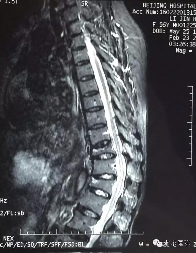 骨科医生教你改善驼背,北京哪家医院治疗脊椎弯曲驼背