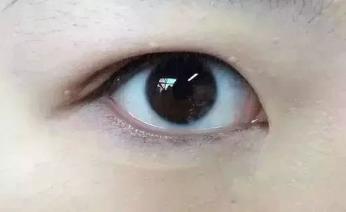 内双眼皮怎么变外双费用多少,眼皮一个内双一个外双怎么矫正