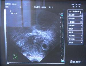 了解胎囊、胎芽、胎心到底是什么？