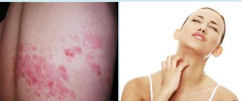 孕期肚子痒能不能挠,孕中期肚子痒挠了有什么危害