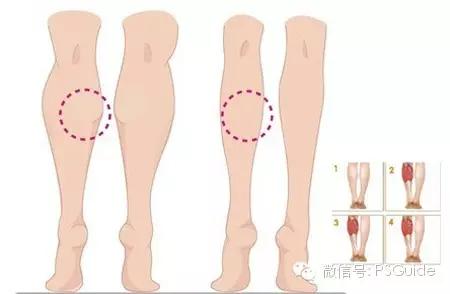 瘦腿针有没有效果,打了瘦腿针走路多影响效果吗