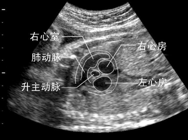 胎囊没有胎心胎芽是什么样的,有胎囊没有胎心胎芽什么原因