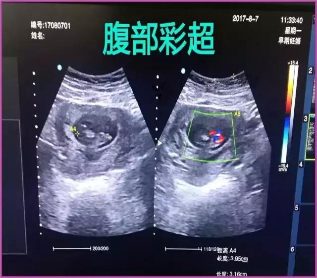 B超彩超有什么区别,妇科b超和阴超的区别