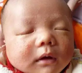 如何区分痱子和湿疹婴儿,湿疹和痱子怎么判断