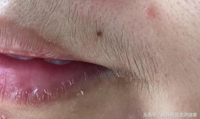 需要动手术才能切的痣有必要吗,医生建议切除的痣一定是不好的吗