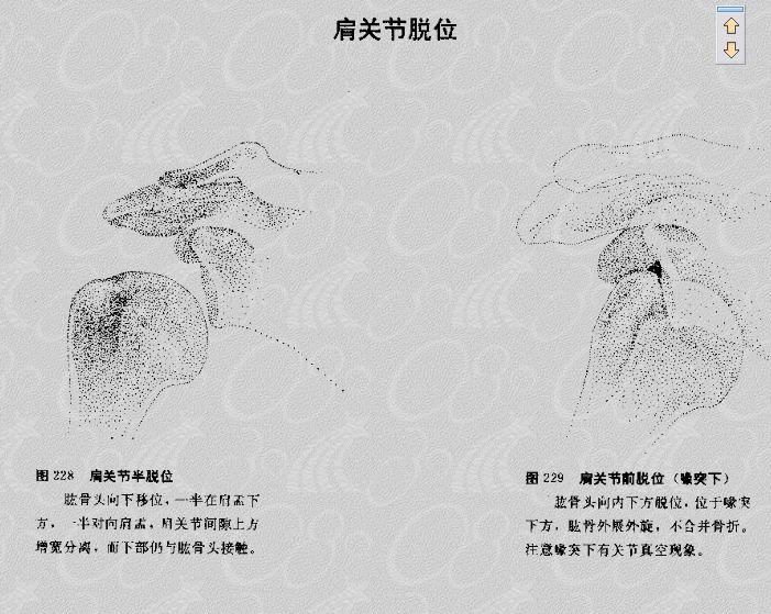 偏瘫的相关知识,偏瘫中医诊断叫什么