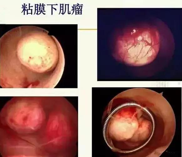 有哪些不良症状要做宫腔镜检查,一般什么情况才会做宫腔镜检查