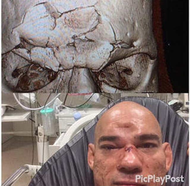 擂台飞膝盖命中对手,格斗擂台飞膝威力