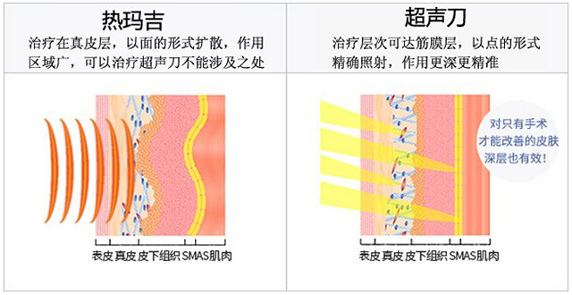 超声刀和热玛吉区别适合人群,热玛吉和超声刀该怎么选
