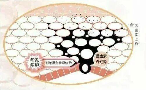 痘印一直不消除是怎么回事,痘印为什么一直消不下去
