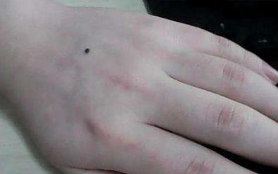 女人右手手背突然长痣代表什么,女人左手手背上有颗痣