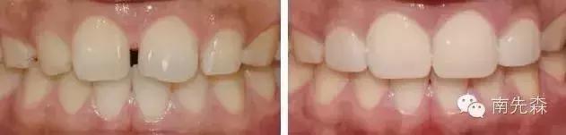 一周快速脸部美白小妙招,美容冠的形态怎么做的