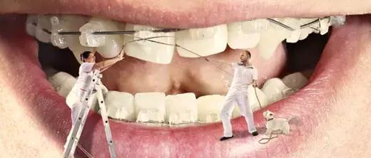 牙套上的丑钢丝,牙套上钢丝有一点锈