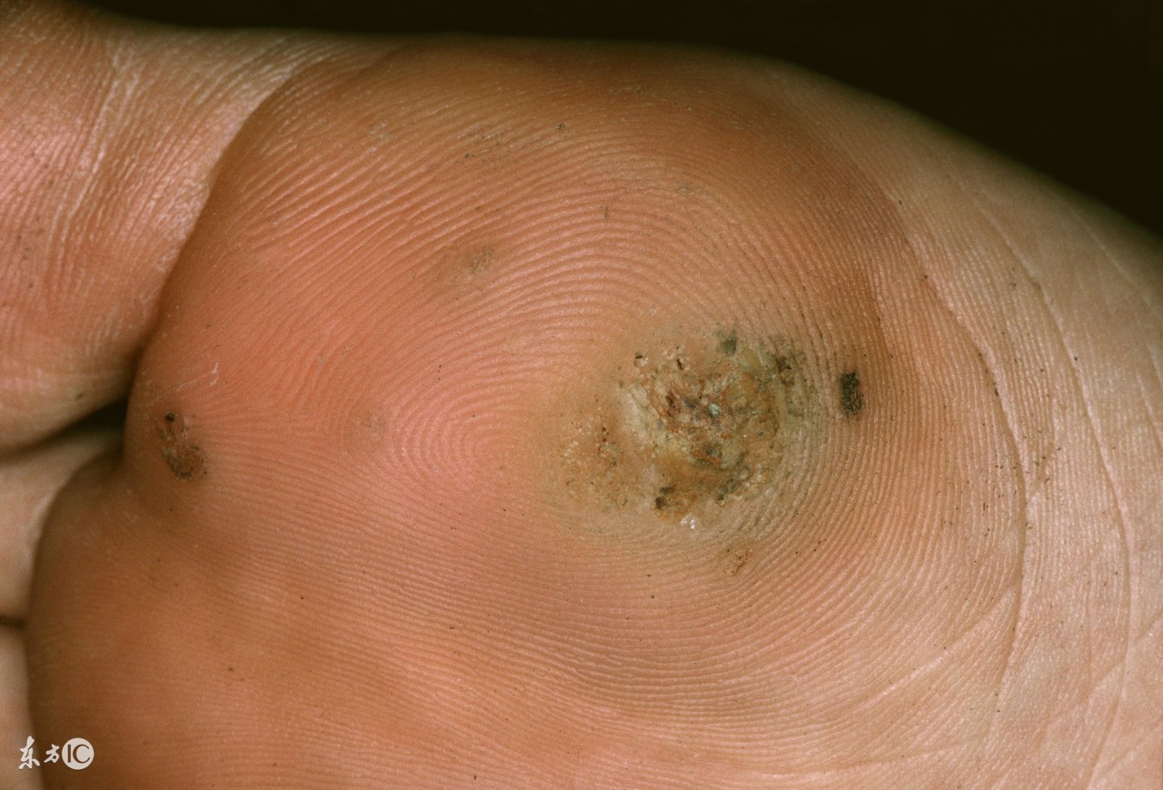 12岁脚上瘊子疣最简单的去除方法,女子祛扁平疣花费近3万