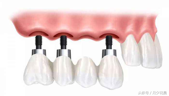 张春阳医生关于种植牙的那些事,种植牙那些事儿