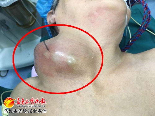老人颈部巨瘤手术,八旬老人摘除巨瘤