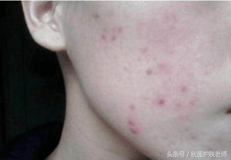 去除红色痘印最有效的方法,怎么祛除红色痘印最有效的方法