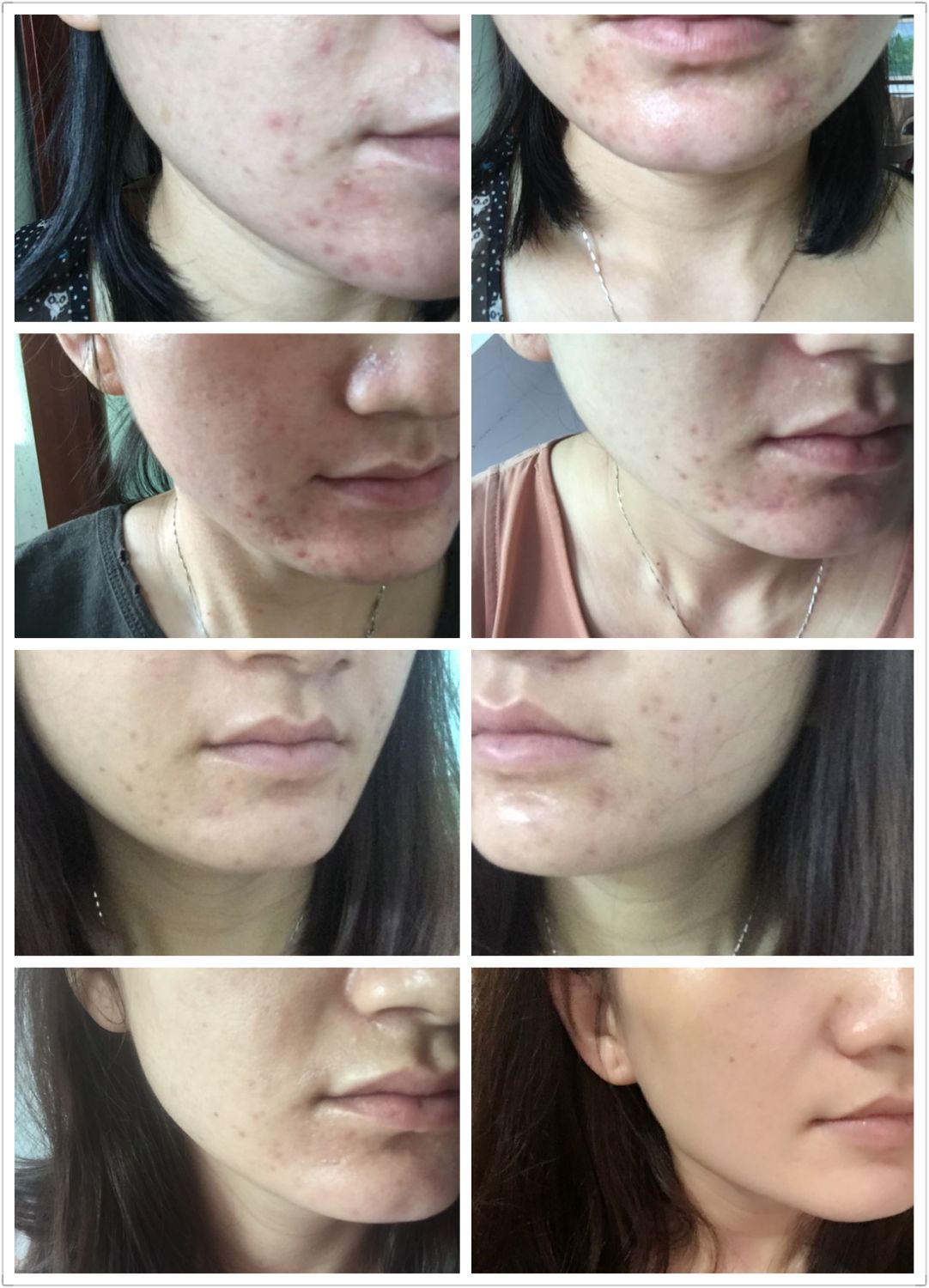 敏感肌修复瑞玲老师8000肤诊案例连载004-激素脸老是反复怎么办