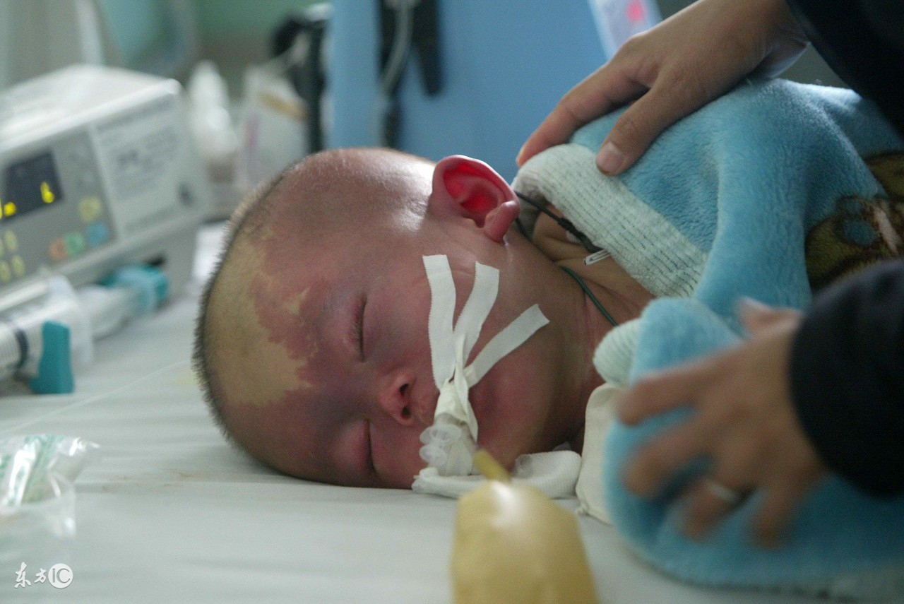 小儿脑积水的护理,小儿脑积水治疗最佳方法