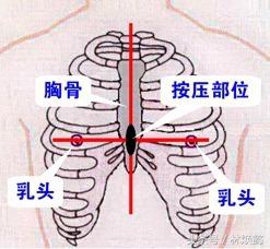 心肺复苏按断老人12根肋骨,如何判断断了一根肋骨