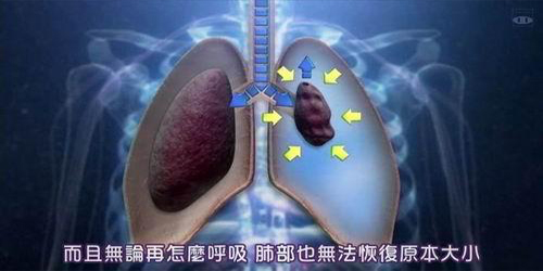 肺结核做了介入手术以后的并发症,肺结核引起相关临床症状