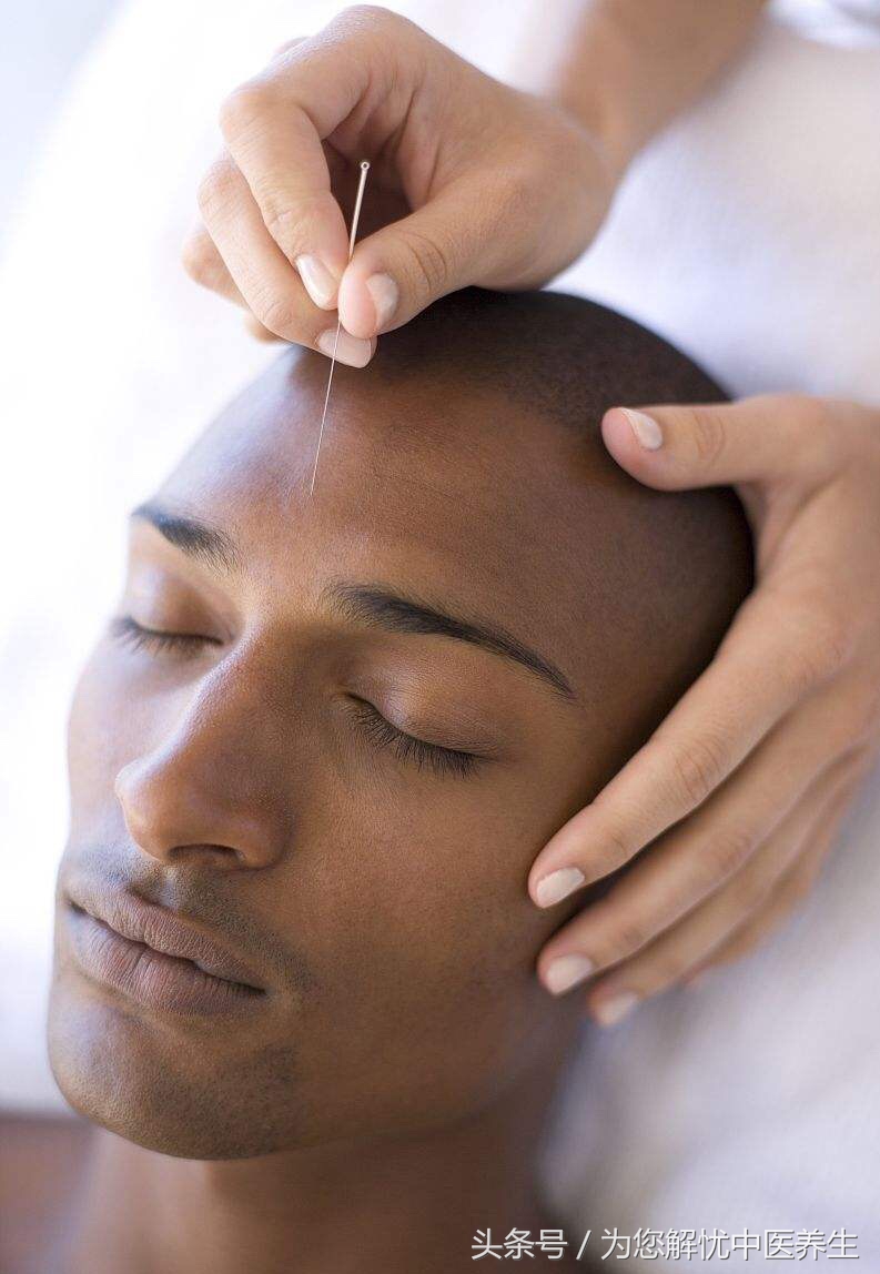 针刺治疗面瘫的图片,面瘫最佳针刺疗法视频